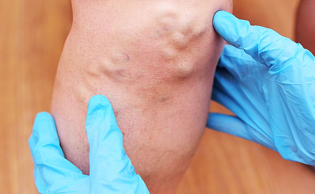 Multiple Lipoma Removal