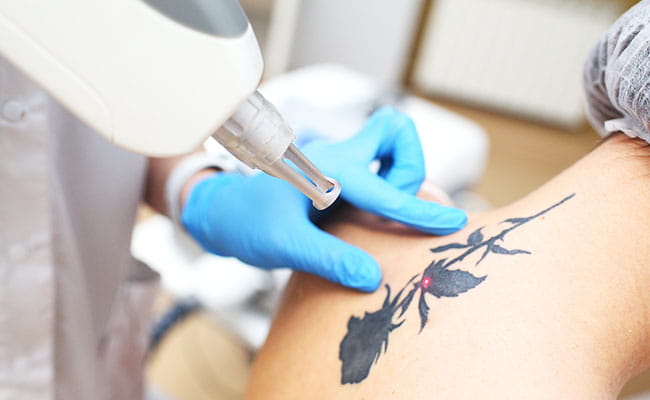 Tattoo Removal